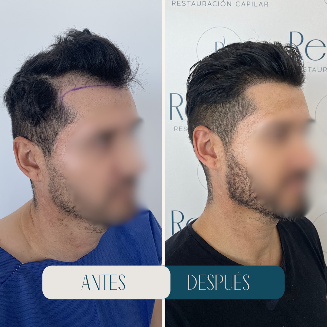 Injerto capilar zona frontal · antes y después · Revitalit Querétaro