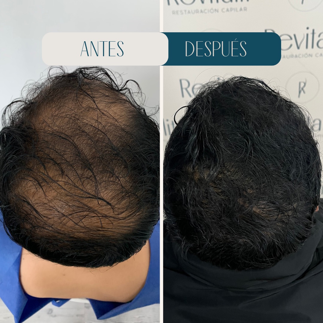 Injerto capilar en coronilla · antes y después · Revitalit Querétaro