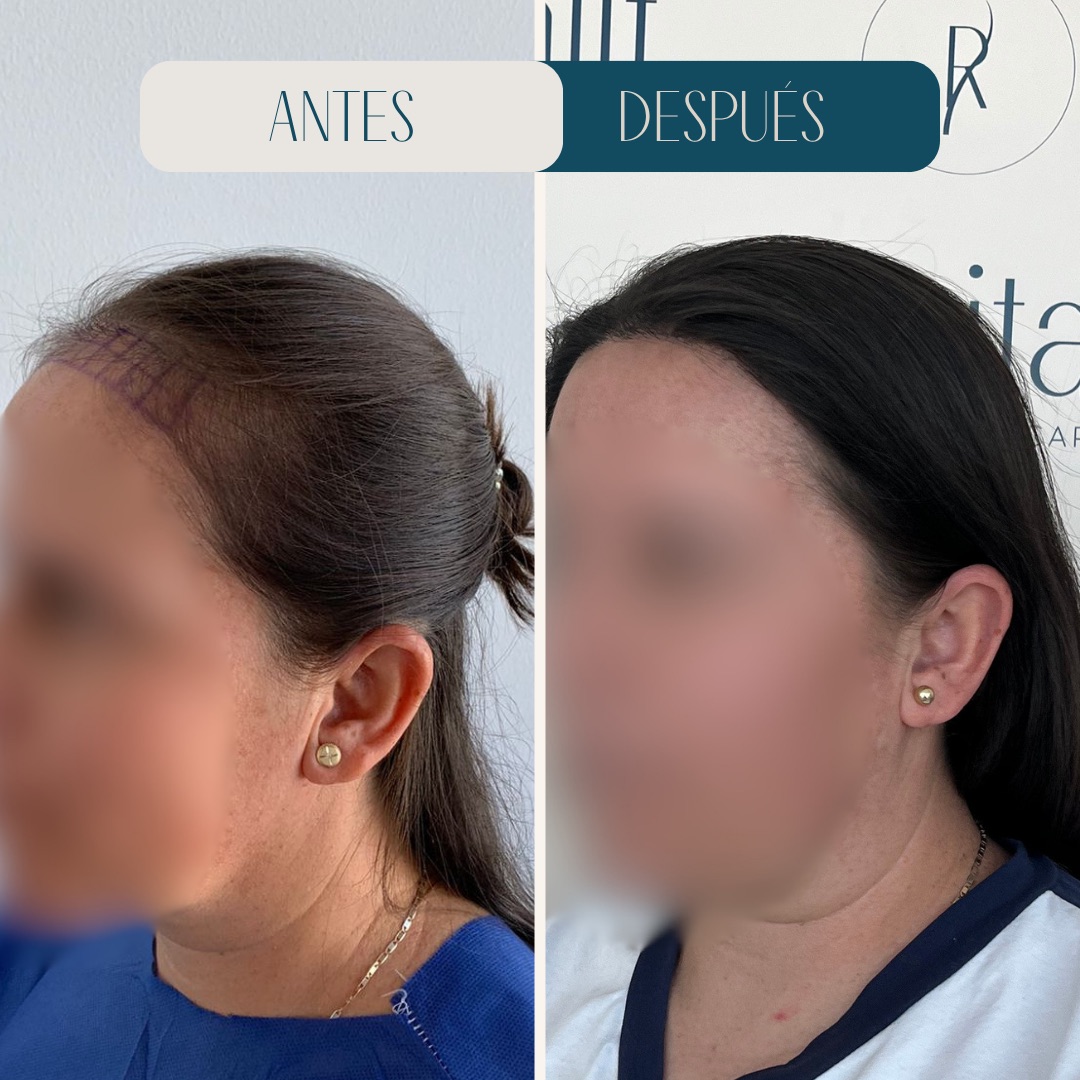Injerto capilar en mujer · línea frontal antes y después · Revitalit