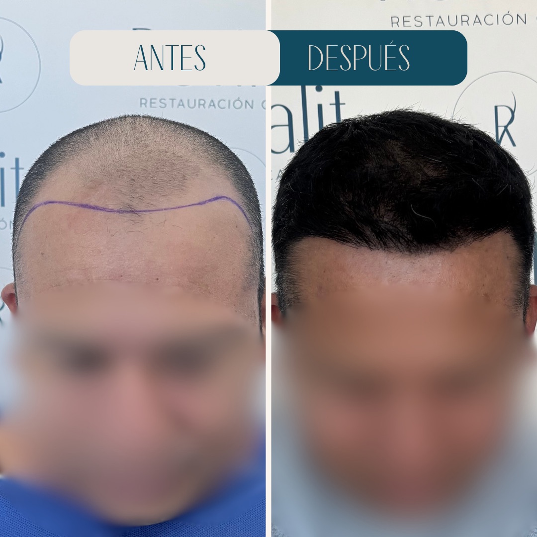 Injerto capilar línea frontal densa · antes y después · Revitalit