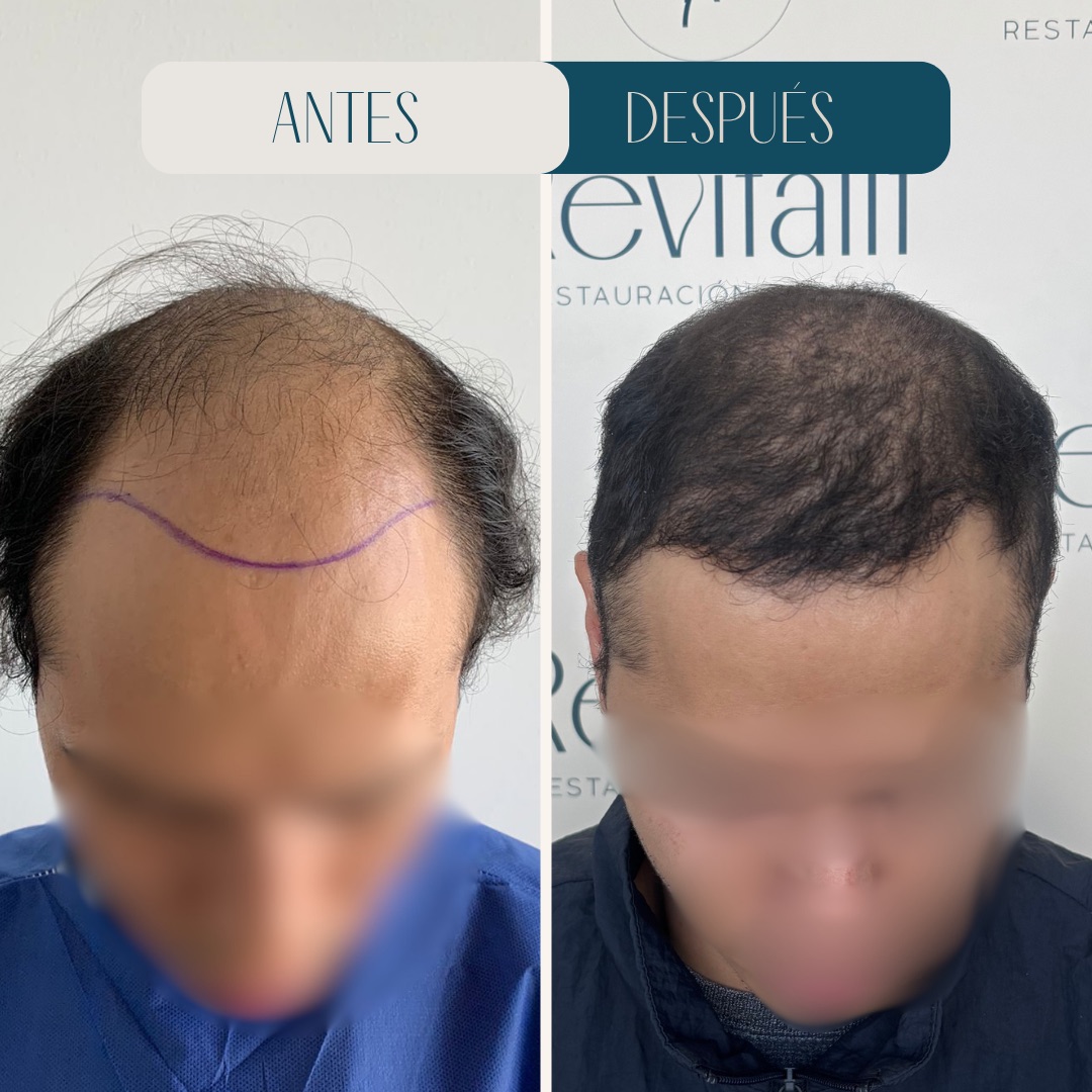 Injerto capilar frontal · densificación antes y después · Revitalit