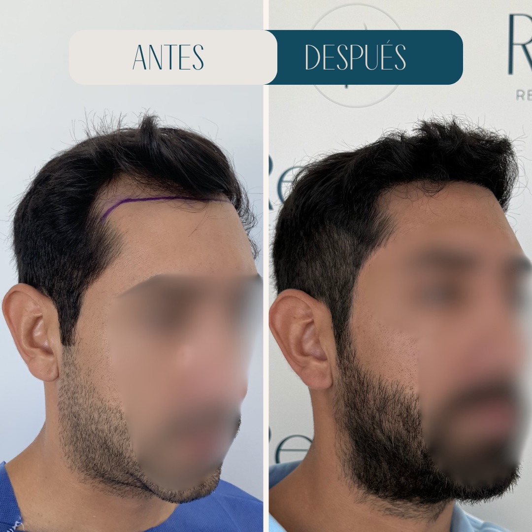 Injerto capilar entradas y perfil · antes y después · Revitalit Querétaro