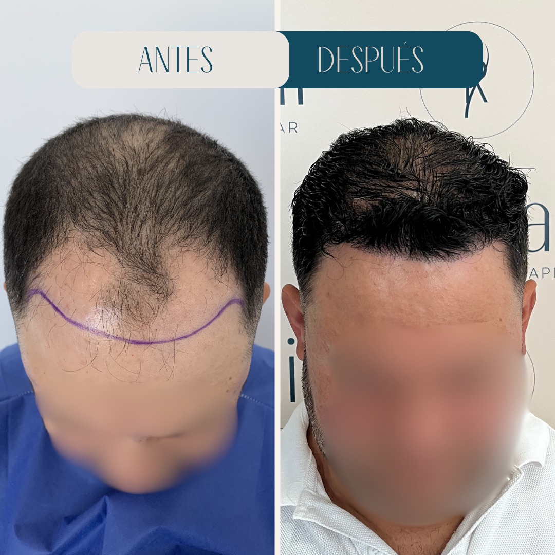 Injerto capilar frontal avanzado · antes y después · Revitalit