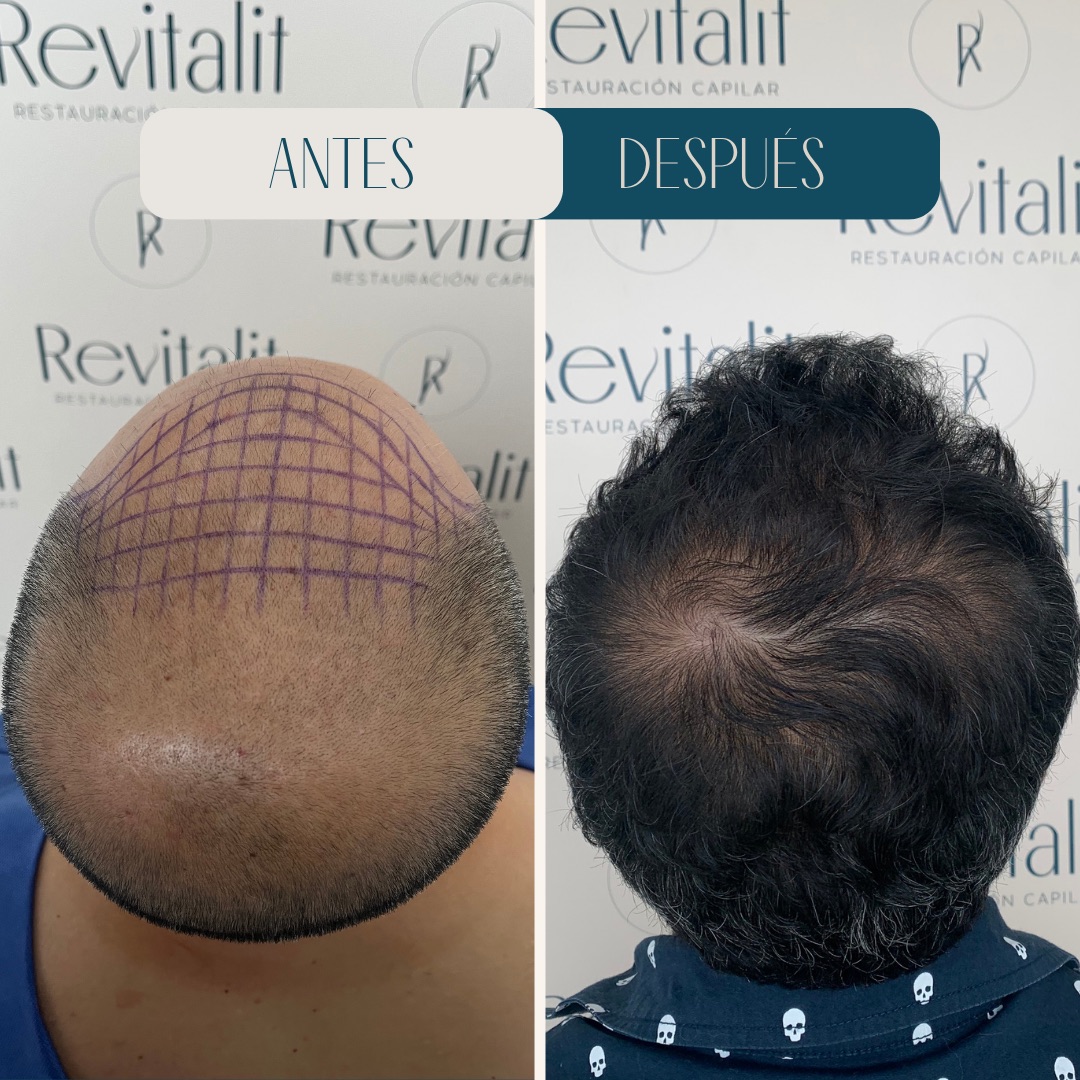 Injerto capilar en coronilla · diseño y resultado · antes y después · Revitalit
